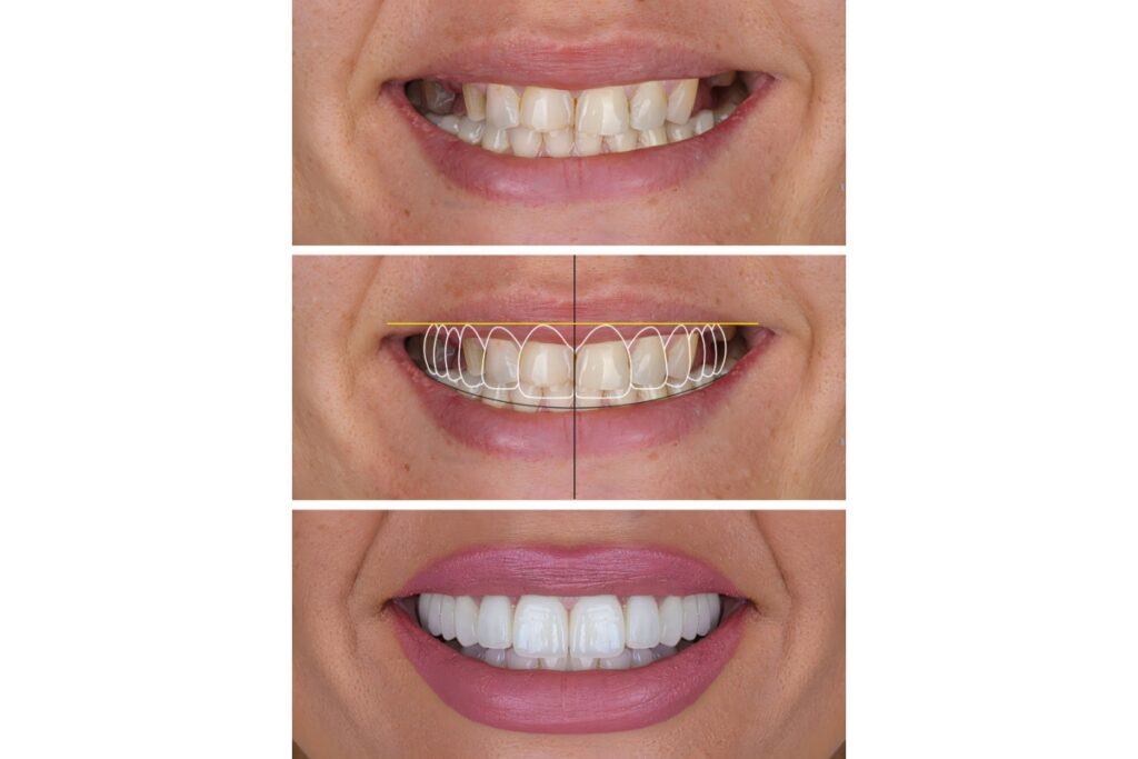 Before and after comparison showing chipped and discolored front teeth transformed with dental veneers, demonstrating restorative cosmetic dental treatment results.