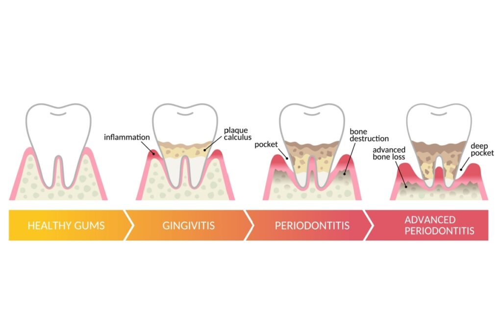 Dental diagram showing four stages of gum disease progression from healthy gums through gingivitis, periodontitis, and advanced periodontitis with labels for inflammation, plaque, calculus, pockets, and bone loss.