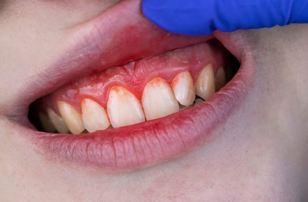 Close-up view of patient mouth showing red and inflamed gums during dental examination with blue gloved hands demonstrating signs of gingivitis.