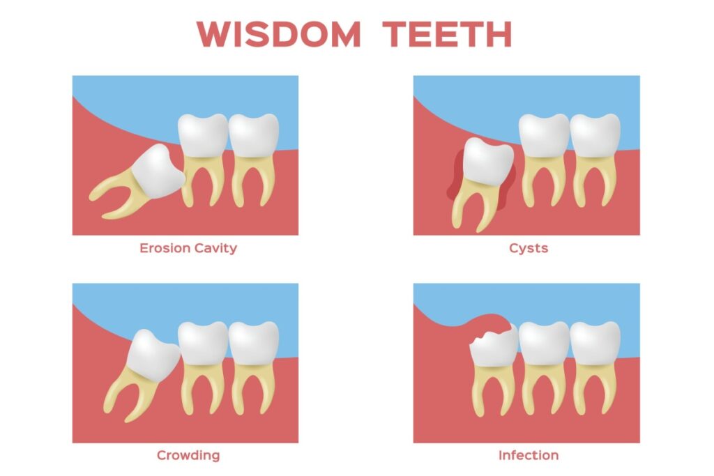 Educational dental diagram displaying four common wisdom teeth problems including erosion cavity with horizontal impaction, cyst formation around tooth, crowding of adjacent teeth, and infection in gum tissue shown in cross-sectional illustrations.