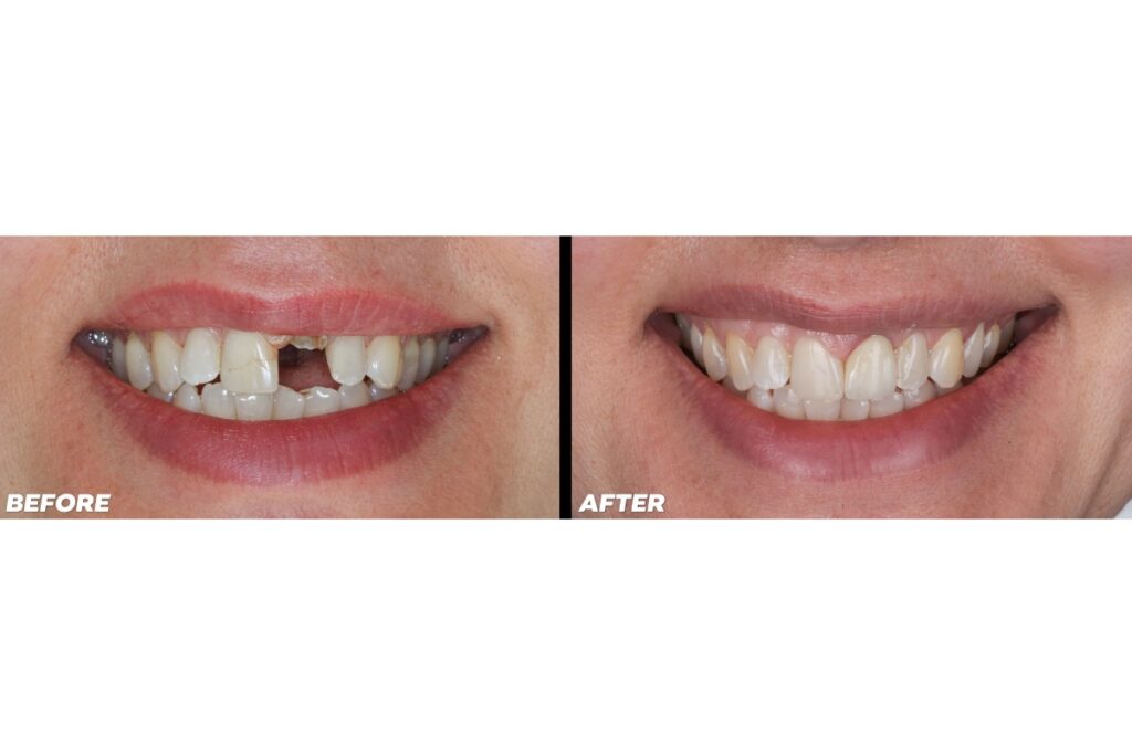 Before and after missing front tooth.