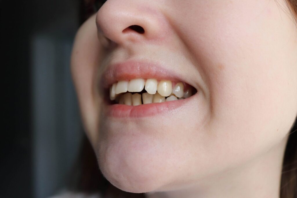 Close up image of person with overbite.