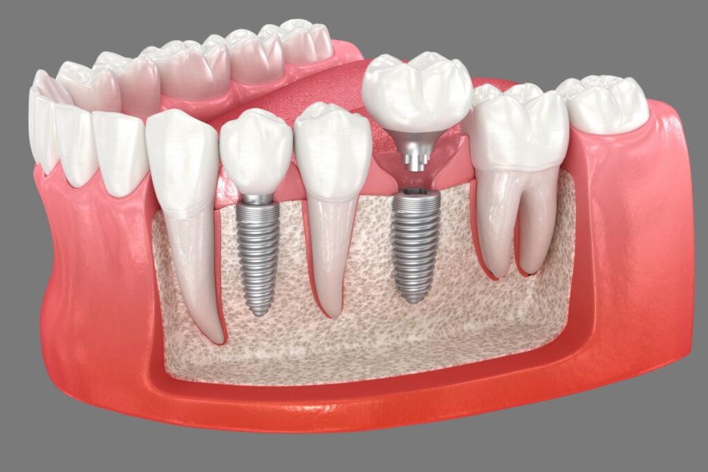 Digital model of jaw with dental implant.